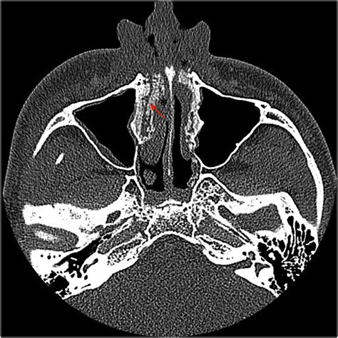 Secondary Acquired Nasolacrimal Duct Obstruction 